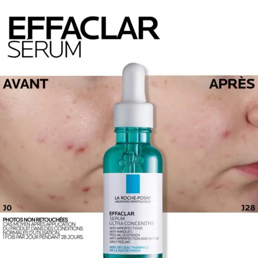 Avant et après 28 jours d'utilisation du sérum Effaclar Ultra Concentré pour traiter l'acné.