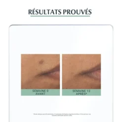 Résultats avant et après 12 semaines d'utilisation du sérum Eucerin DermoPure
